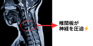 頚椎MRI