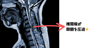 頚椎椎間板ヘルニアのMRI画像