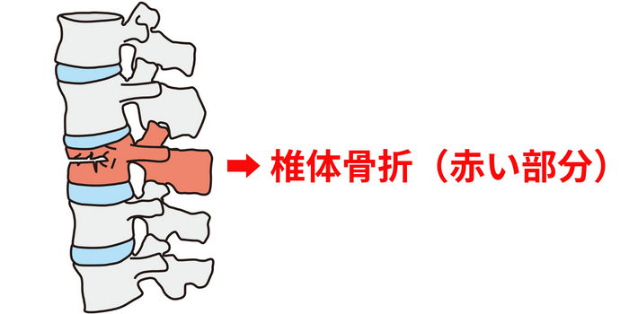 骨粗鬆症性椎体骨折 | 名倉医院 駅前クリニック 整形外科 北千住駅徒歩2分