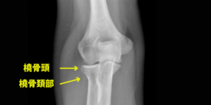 肘関節レントゲン画像