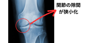 変形性膝関節症のレントゲン写真